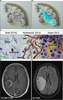 Therapeutic Potential of Selenium in Glioblastoma